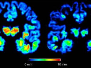 cerveau-alzheimer-cortex cerveau-alzheimer-cortex