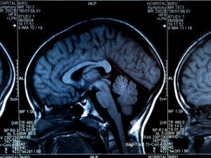 Un scan du cerveau Un scan du cerveau