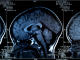 Un scan du cerveau Un scan du cerveau