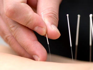 acupuncture acupuncture