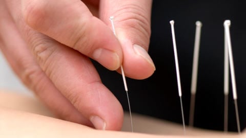 acupuncture acupuncture
