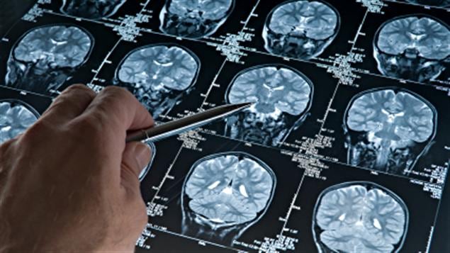 cerveau-scan-commotion cerveau-scan-commotion