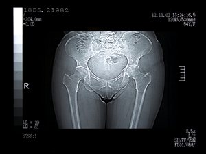 Radiographie du bas du corps d'une femme