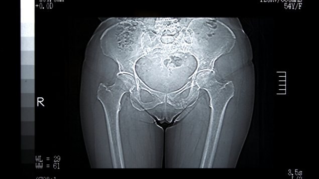 Radiographie du bas du corps d'une femme Radiographie du bas du corps d'une femme