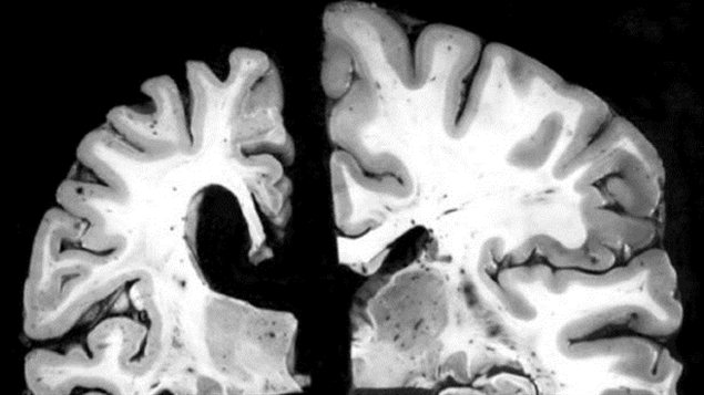 À gauche, le cerveau d'une personne de 70 ans atteinte de l'alzheimer. À droite, le cerveau d'une personne de 70 ans qui ne présente aucune trace de la maladie. À gauche, le cerveau d'une personne de 70 ans atteinte de l'alzheimer. À droite, le cerveau d'une personne de 70 ans qui ne présente aucune trace de la maladie.