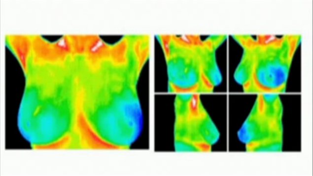 Images par thermographie de seins Images par thermographie de seins