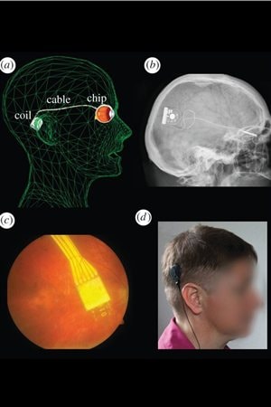 Schéma, radiographie et photos montrant l'emplacement de l'implant, du câble et de l'appareillage Schéma, radiographie et photos montrant l'emplacement de l'implant, du câble et de l'appareillage