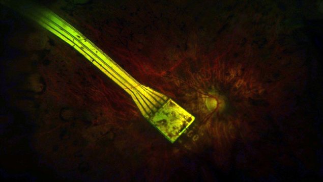 L'implant placé au niveau de la rétine L'implant placé au niveau de la rétine