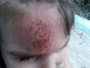 Selon la mère, sa fille a été blessée lors de l'altercation à la pataugeoire d'Outremont. Selon la mère, sa fille a été blessée lors de l'altercation à la pataugeoire d'Outremont.