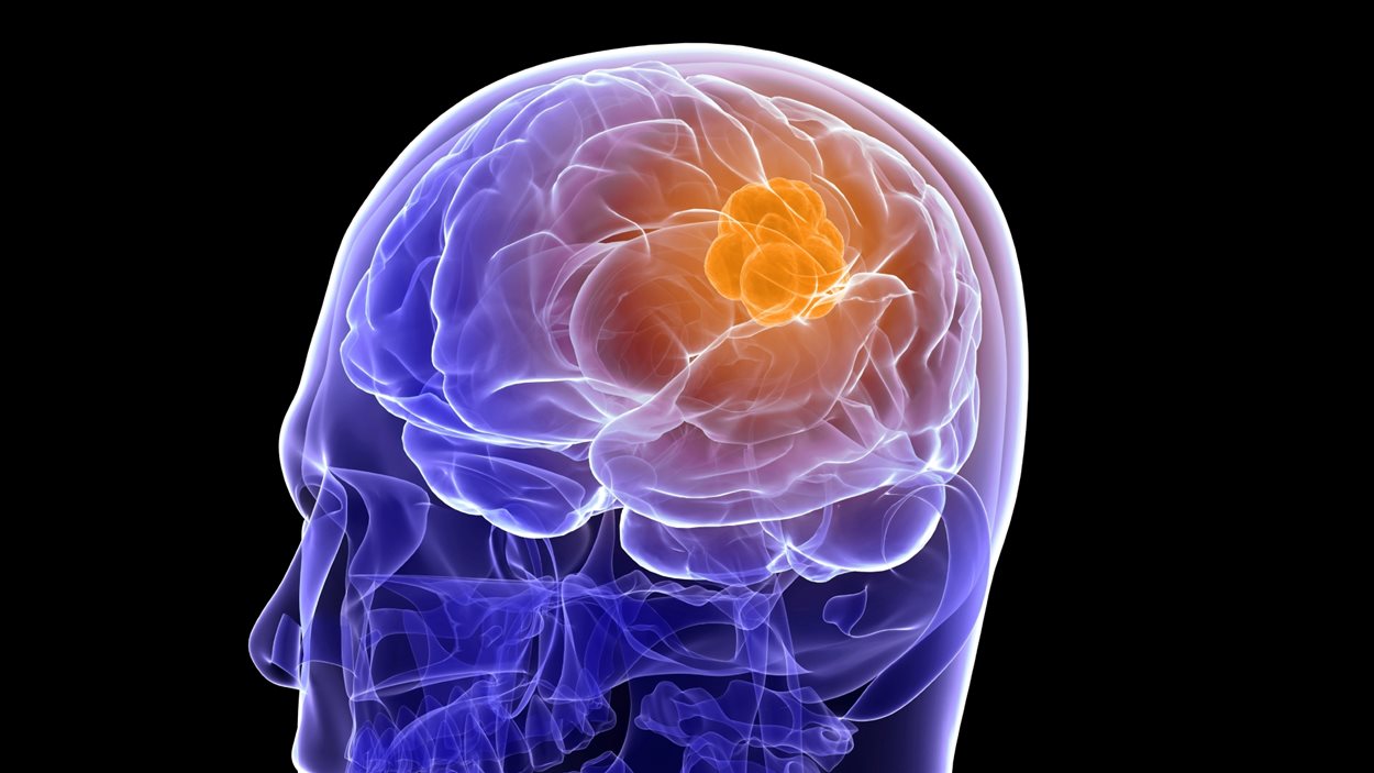 Nouvel Outil Contre Le Cancer Du Cerveau | ICI.Radio-Canada.ca