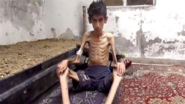 Cette photo non datée diffusée par le Conseil révolutionnaire local de Madaya montre un garçon amaigri jusqu'aux os. Associated Press affirme avoir vérifié l'authenticité de cette photo. Cette photo non datée diffusée par le Conseil révolutionnaire local de Madaya montre un garçon amaigri jusqu'aux os. Associated Press affirme avoir vérifié l'authenticité de cette photo.