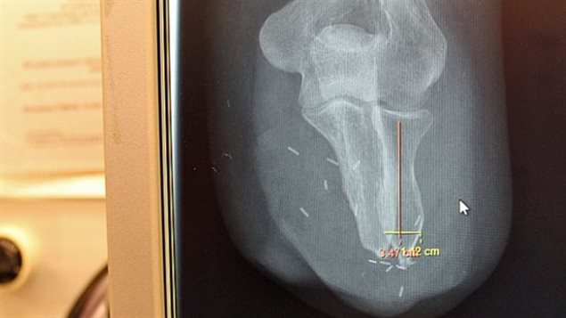 Une radiographie du coude de la patiente est affichée pour guider l'équipe médicale. Une radiographie du coude de la patiente est affichée pour guider l'équipe médicale.