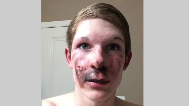 Ty Greer a subi des brûlures importantes au visage à cause d'une cigarette électronique. Ty Greer a subi des brûlures importantes au visage à cause d'une cigarette électronique.