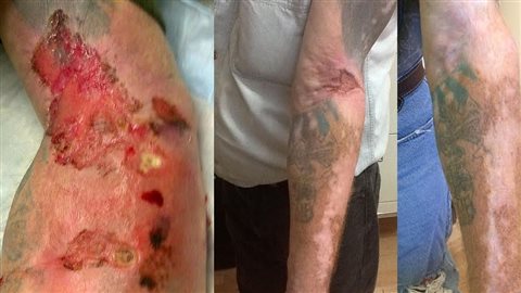 À gauche, le bras de Terry Steeves à l'époque où il s'injectait des drogues; à droite, son bras aujourd'hui. À gauche, le bras de Terry Steeves à l'époque où il s'injectait des drogues; à droite, son bras aujourd'hui.