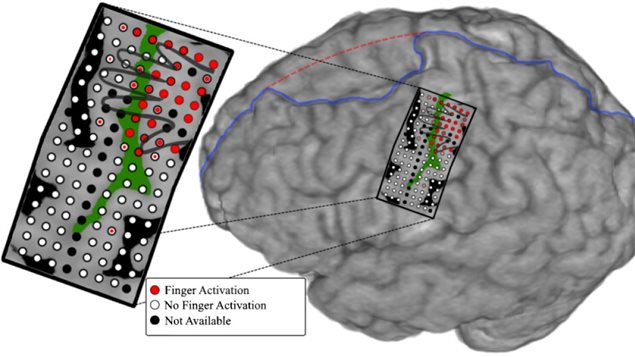 Illustration montrant le réseau d'électrodes placé sur le cerveau du sujet, et représentation de quelle partie du cerveau contrôle chaque doigt. Illustration montrant le réseau d'électrodes placé sur le cerveau du sujet, et représentation de quelle partie du cerveau contrôle chaque doigt.
