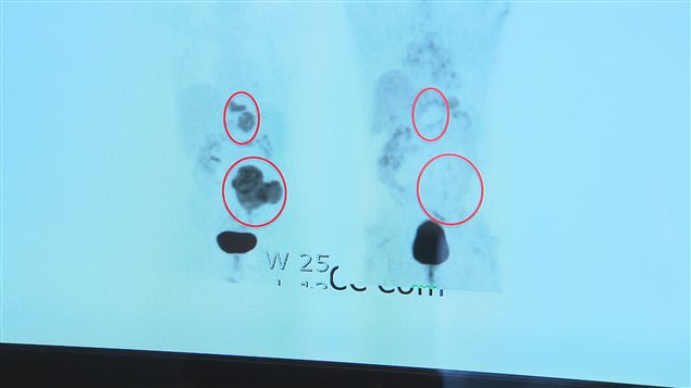 Virothérapie : le cancer de ce patient a disparu Virothérapie : le cancer de ce patient a disparu