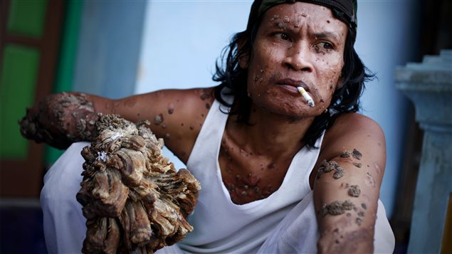 Dede Koswara, surnommé l'homme-arbre, dans son village de Bandung, à Java, en Indonésie, le 16 décembre 2009. Il souffre d’une forme du virus du papillome humain (PVH). Dede Koswara, surnommé l'homme-arbre, dans son village de Bandung, à Java, en Indonésie, le 16 décembre 2009. Il souffre d’une forme du virus du papillome humain (PVH).