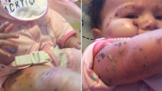 L'enfant de 5 mois a des irritations et des lésions sur tout le corps. L'enfant de 5 mois a des irritations et des lésions sur tout le corps.