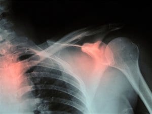 Les os du bras lors d'une radiographie Les os du bras lors d'une radiographie