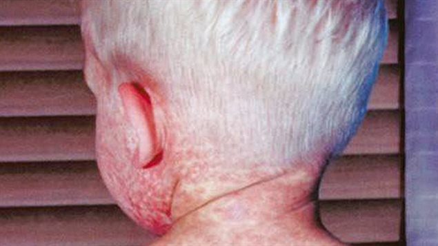 Un enfant atteint de rougeole. Un enfant atteint de rougeole.