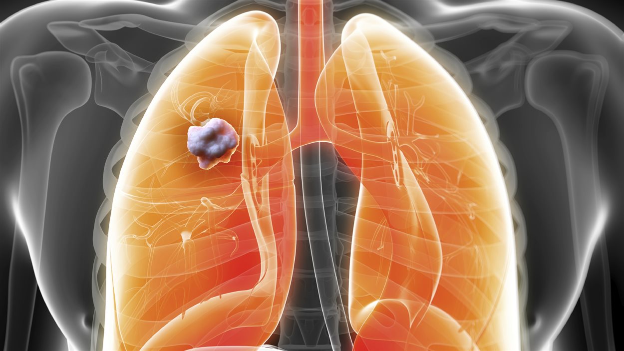 Une tumeur pulmonaire Une tumeur pulmonaire