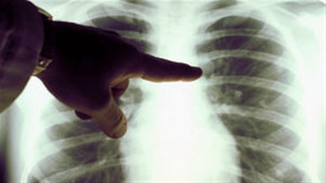 Le nombre de nouveaux cas de cancer bondira d'au moins 35% au Québec dans les 15 prochaines années. C'est ce que nous apprend un nouveau rapport publié hier par la Société canadienne du cancer en collaboration avec l'Agence de la santé publique du Canada et Statistique Canada. Le docteur Pierre Hallé est chef du Service de gastro-entérologie au CHU de Québec.
Le nombre de nouveaux cas de cancer bondira d'au moins 35% au Québec dans les 15 prochaines années. C'est ce que nous apprend un nouveau rapport publié hier par la Société canadienne du cancer en collaboration avec l'Agence de la santé publique du Canada et Statistique Canada. Le docteur Pierre Hallé est chef du Service de gastro-entérologie au CHU de Québec.