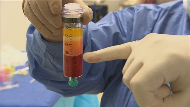 Le Dr Jacques Toueg montre une seringue contenant un concentré de plaquettes de plasma sanguin, composé de cellules souches du tissu graisseux et de sang, an août 2016. Le contenu sera injecté dans le genou d'un patient souffrant d'arthrose. Le Dr Jacques Toueg montre une seringue contenant un concentré de plaquettes de plasma sanguin, composé de cellules souches du tissu graisseux et de sang, an août 2016. Le contenu sera injecté dans le genou d'un patient souffrant d'arthrose.