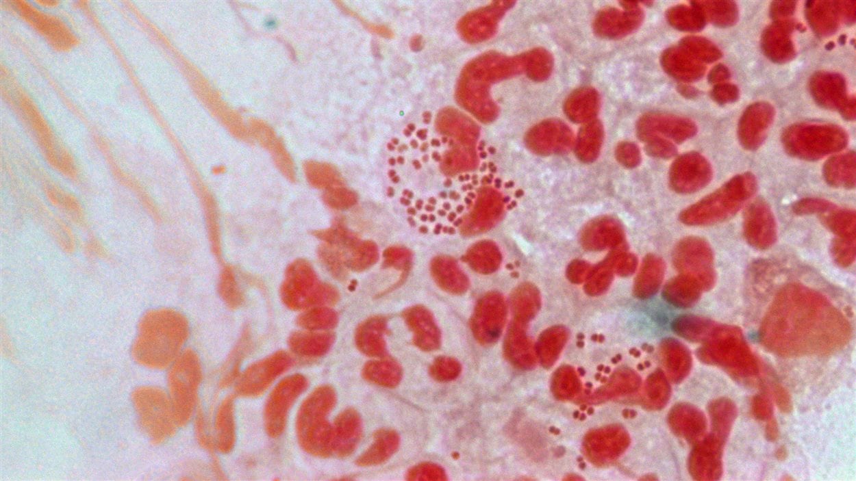 Une culture de gonorrhée résistante aux antibiotiques, vue sous la lentille d'un microscope Une culture de gonorrhée résistante aux antibiotiques, vue sous la lentille d'un microscope